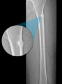 Atypical Femur Fracture